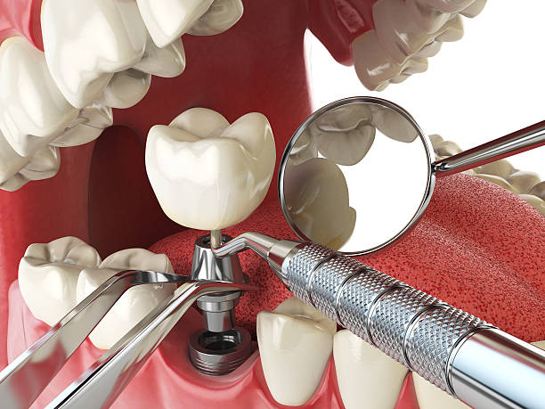 Best Emergency Wisdom Teeth Removal in La Habra Heights, CA